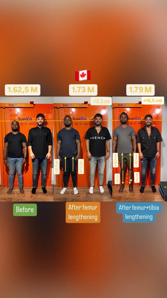 Patient before and after limb lengthening: 162.5 cm to 179 cm, +16.5 cm with femur then femur and tibia lengthening.