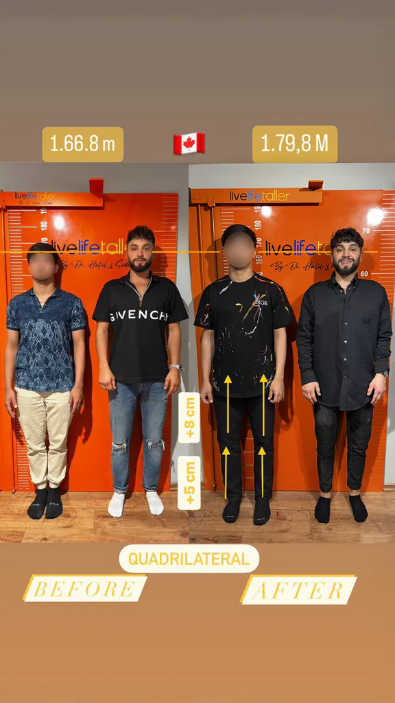 Patient before and after limb lengthening: 166.8 cm to 179.8 cm, +13 cm with quadrilateral lengthening.