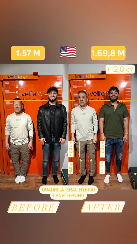 Patient before and after limb lengthening: 157 cm to 169.8 cm, +12.8 cm with quadrilateral hybrid lengthening.