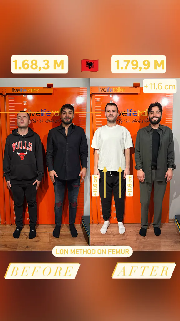 Patient before and after limb lengthening: 168.3 cm to 179.9 cm, +11.6 cm with the LON method on the femur.