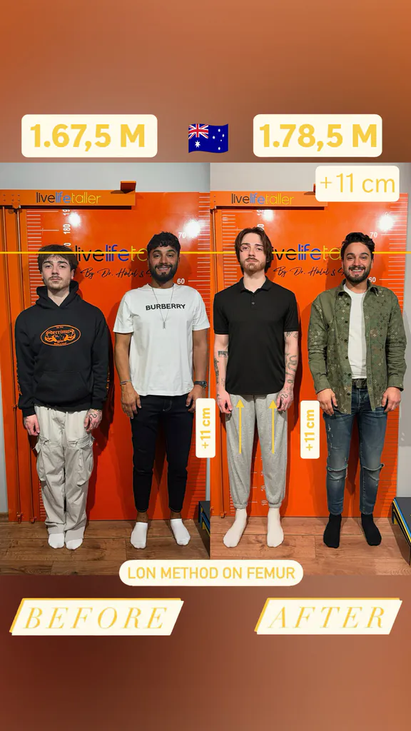 Patient before and after limb lengthening: 167.5 cm to 178.5 cm, +11 cm with the LON method on the femur.