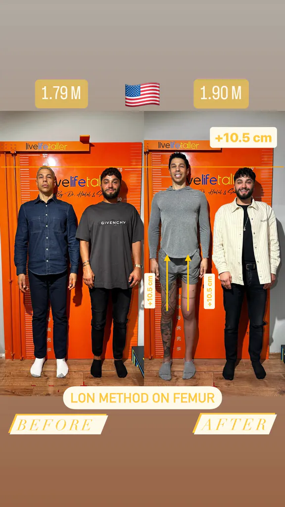 Patient before and after limb lengthening: 179 cm to 190 cm, +11 cm with the LON method on the femur.