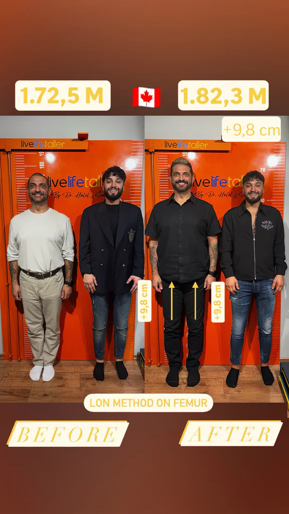 Patient before and after limb lengthening: 172.5 cm to 182.3 cm, +9.8 cm with the LON method on the femur.