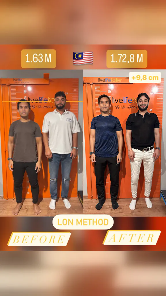 Patient before and after limb lengthening: 163 cm to 172.8 cm, +9.8 cm with the LON method.