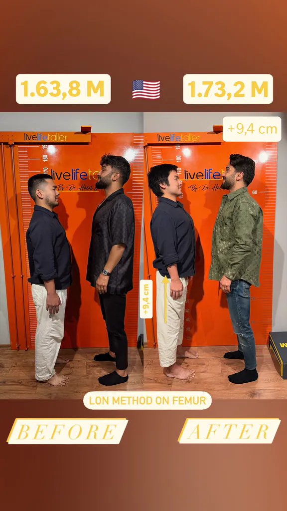 Patient before and after limb lengthening: 163.8 cm to 173.2 cm, +9.4 cm with the LON method on the femur.