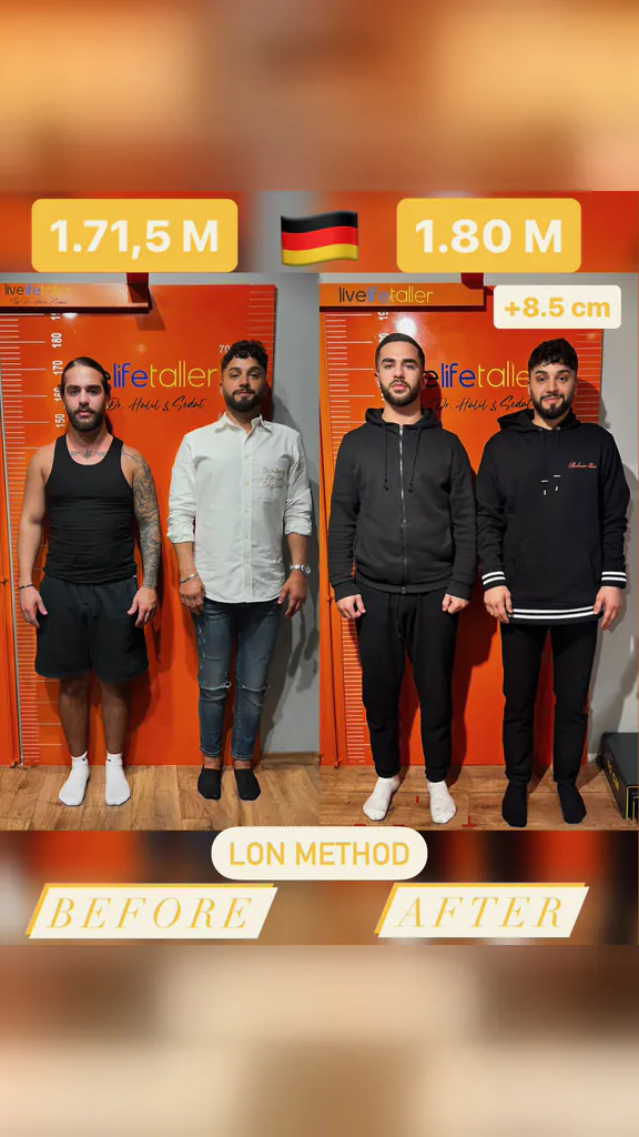 Patient before and after limb lengthening: 171.5 cm to 180 cm, +8.5 cm with the LON method.