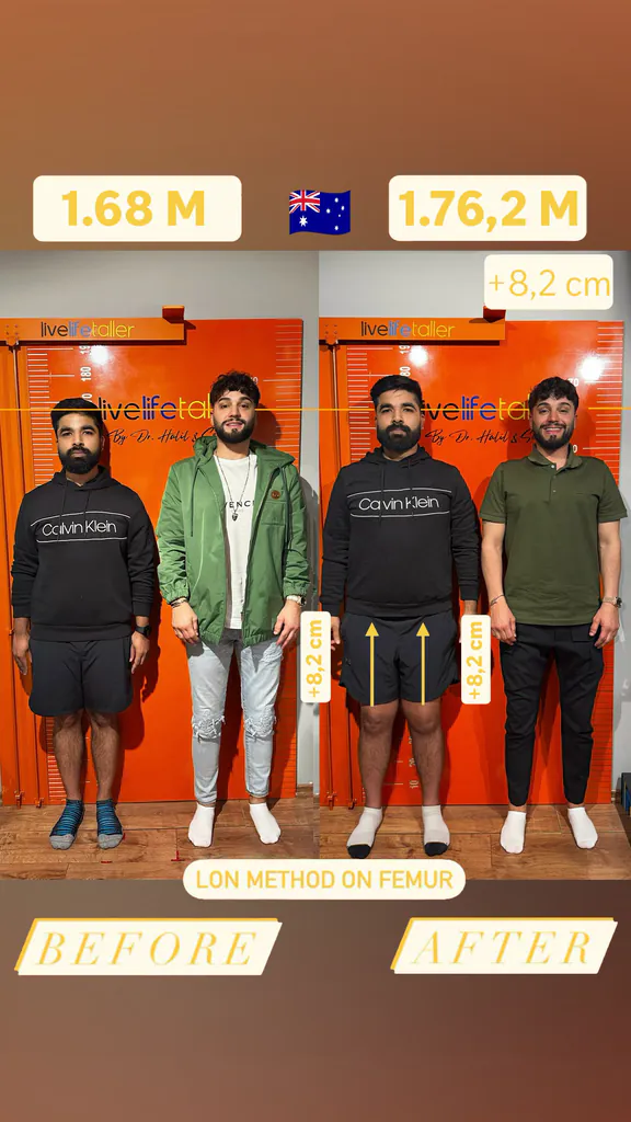 Patient before and after limb lengthening: 168 cm to 176.2 cm, +8.2 cm with the LON method on the femur.