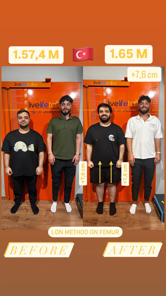Patient before and after limb lengthening: 157.4 cm to 165 cm, +7.6 cm with the LON method on the femur.